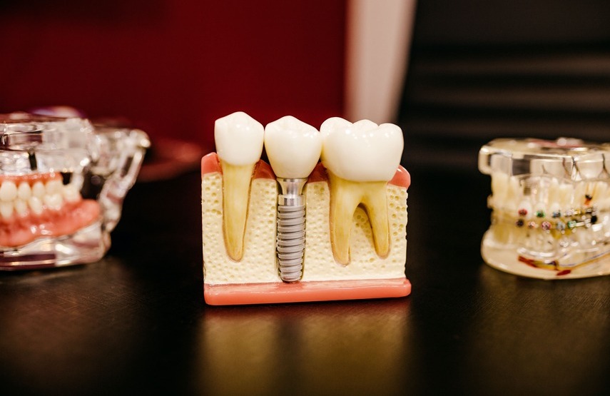 Tiempo entre extracción e implante dental