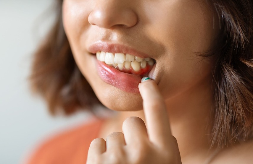 Tratamiento de injerto de encía