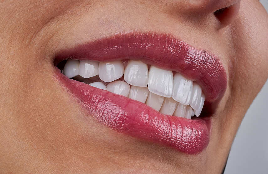 Carillas de composite