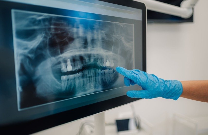 ¿Por qué se aflojan las coronas de los implantes?